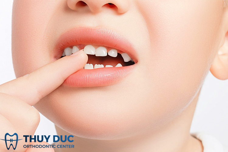 Răng bị lệch lạc, hô móm 1