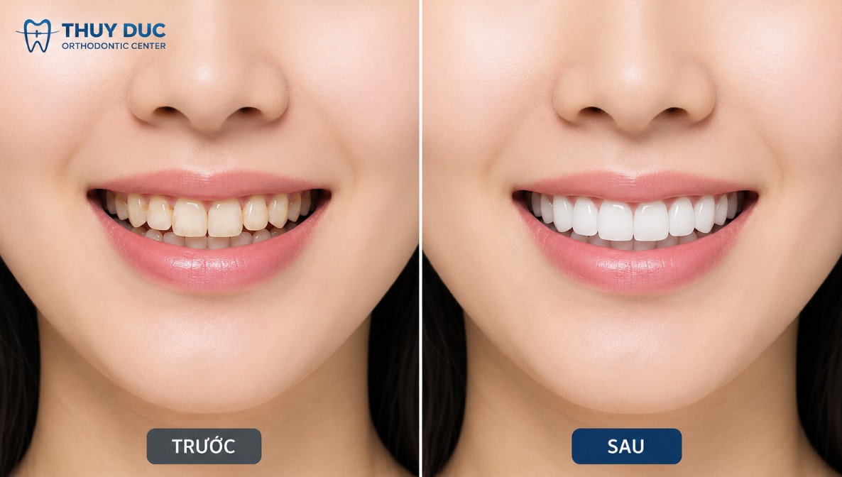 Răng nhiễm màu nặng, không đáp ứng với tẩy trắng 1 Răng nhiễm màu nặng, không đáp ứng với tẩy trắng 1