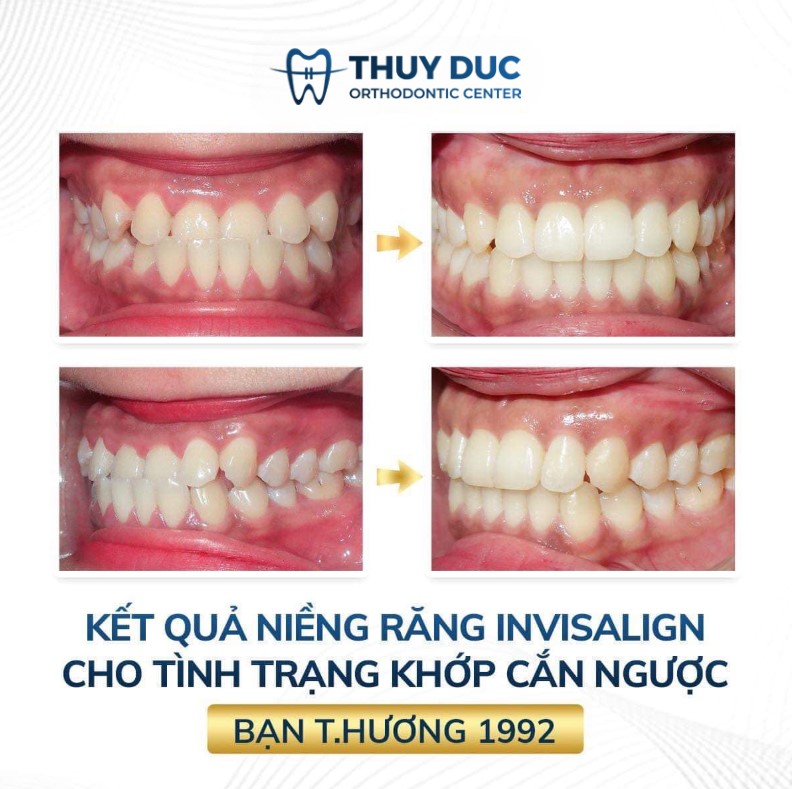 Niềng răng khớp cắn ngược tại Nha khoa Thúy Đức 3