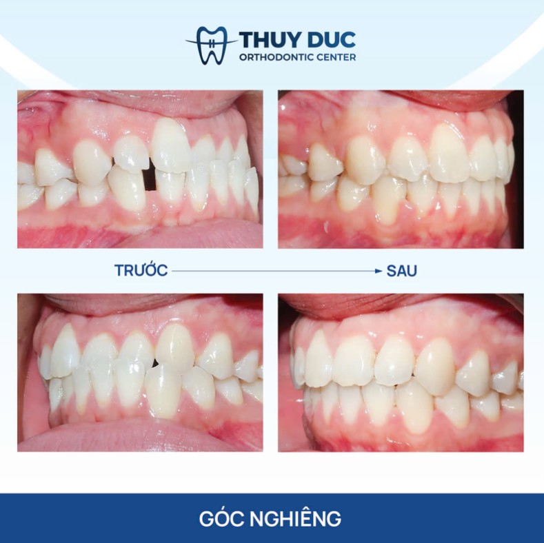 Niềng răng khớp cắn ngược tại Nha khoa Thúy Đức 2