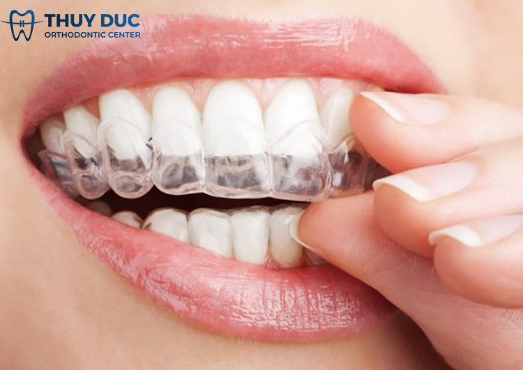 Hàm duy trì sau niềng răng là gì? Phải đeo hàm duy trì trong bao lâu? 1