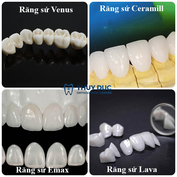 4. Một số loại răng sứ phổ biến hiện nay 1