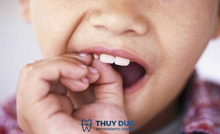 4. Có nên tự nhổ răng sữa cho bé tại nhà? 1