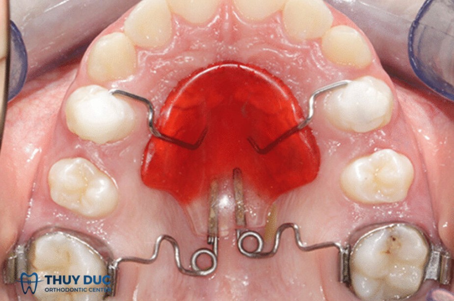 18/ Nhóm khí cụ kéo lùi hàm 1 18/ Nhóm khí cụ kéo lùi hàm 1