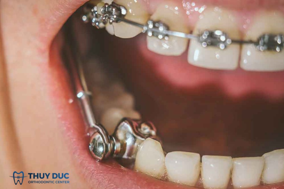 18/ Nhóm khí cụ chỉnh xương/hàm ở người niềng răng đang lớn 1 18/ Nhóm khí cụ chỉnh xương/hàm ở người niềng răng đang lớn 1