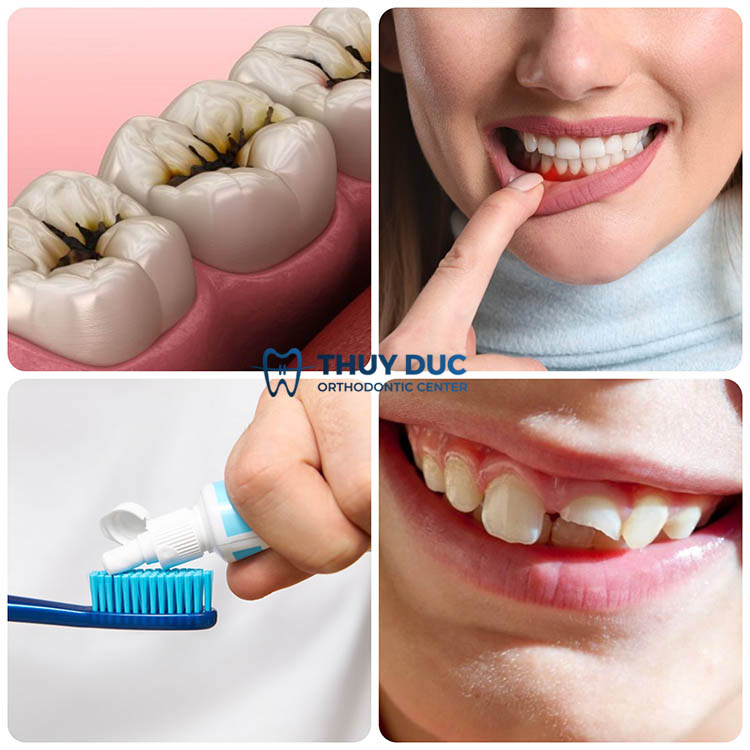 3. Nguyên nhân gây tình trạng áp xe răng là gì? 1