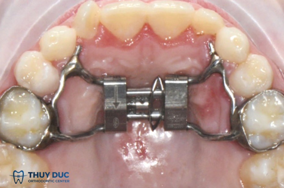 17/ Nhóm khí cụ nong hàm 2 17/ Nhóm khí cụ nong hàm 2