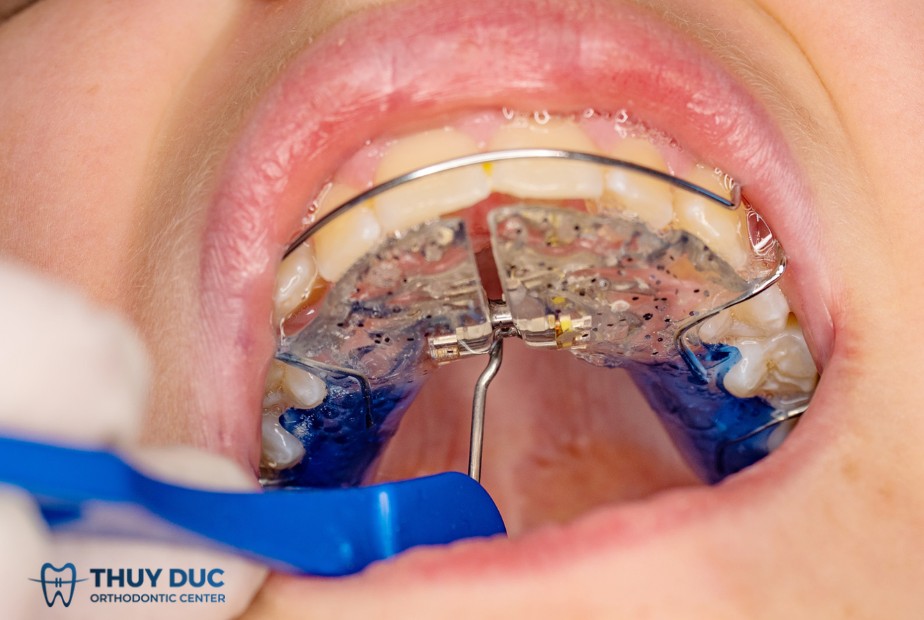 17/ Nhóm khí cụ nong hàm 1 17/ Nhóm khí cụ nong hàm 1