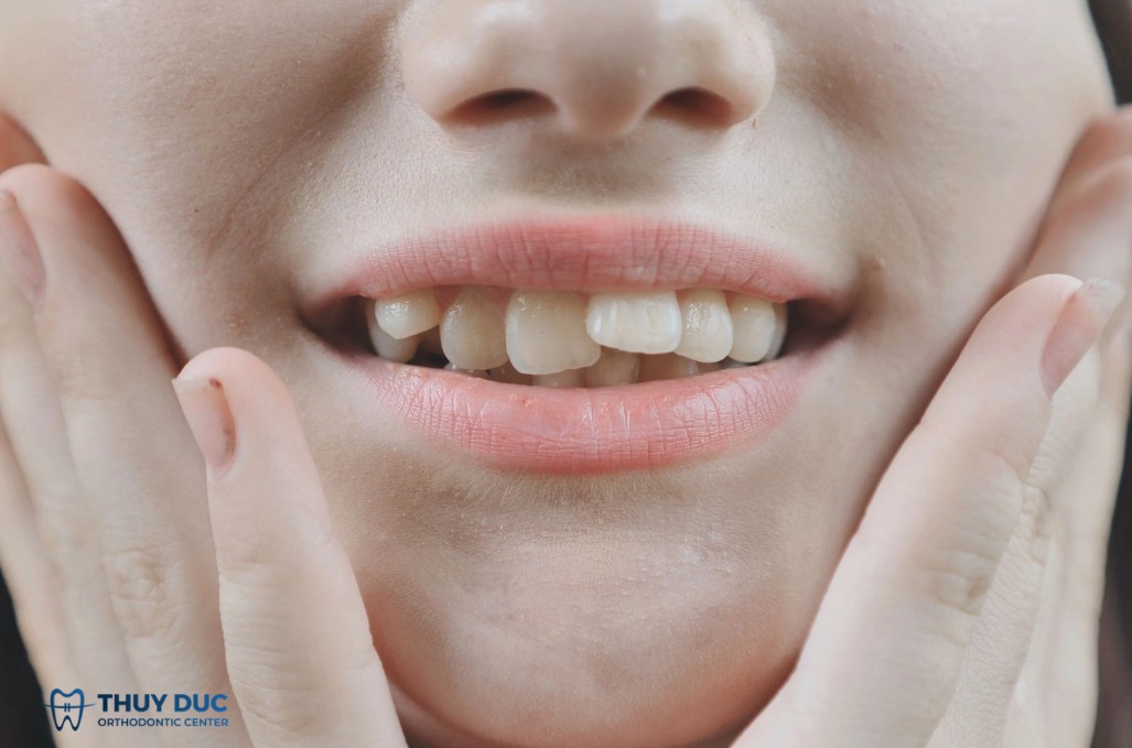 Niềng 2 răng cửa bị lệch có khó không? 1 Niềng 2 răng cửa bị lệch có khó không? 1