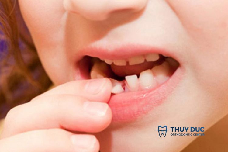1. Vai trò của răng sữa với bé 1