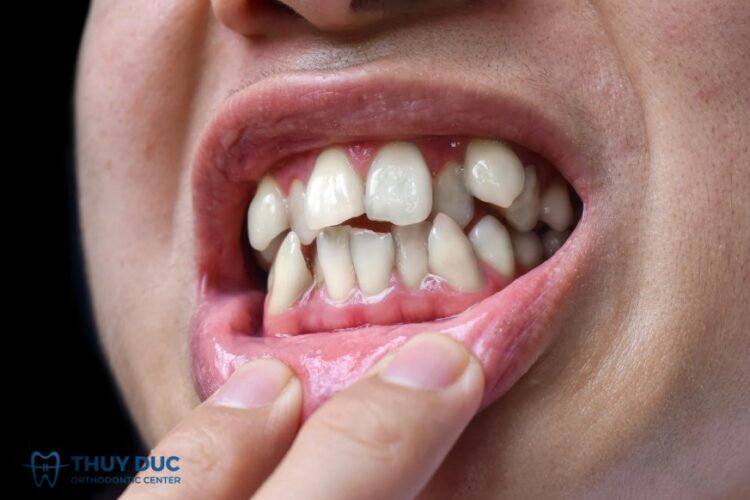 Mức độ phổ biến của sai khớp cắn loại 1 1