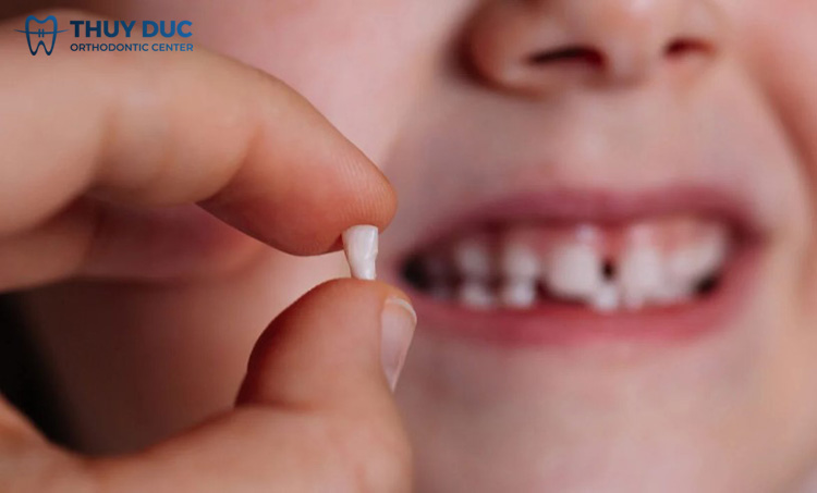 Trẻ bao nhiêu tuổi thì thay răng sữa? 1