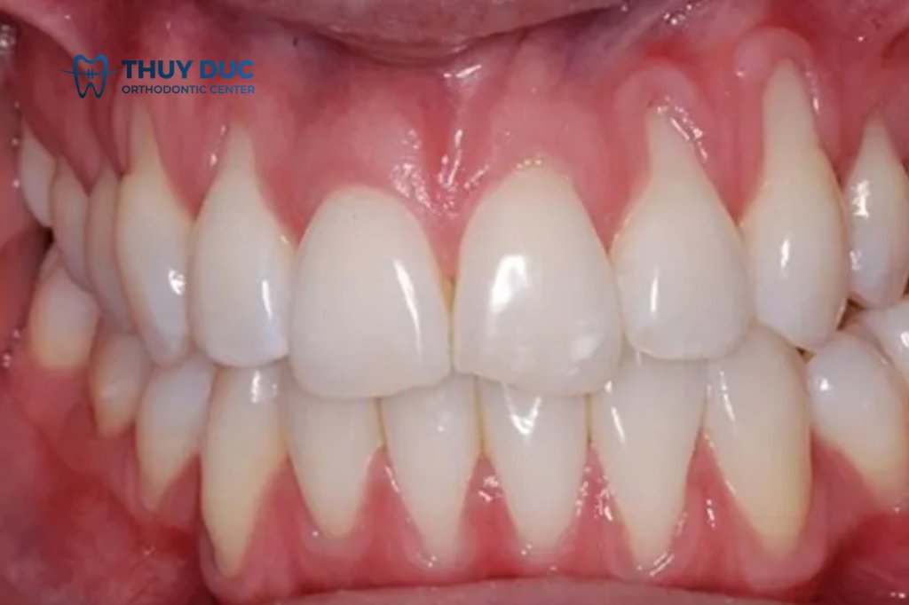 Dấu hiệu bọc răng sứ bị tụt lợi 1