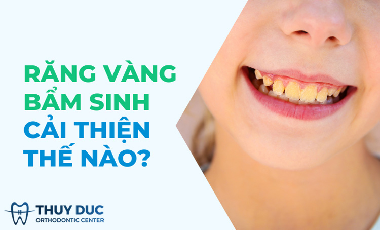 Răng vàng bẩm sinh cải thiện thế nào hiệu quả? 1
