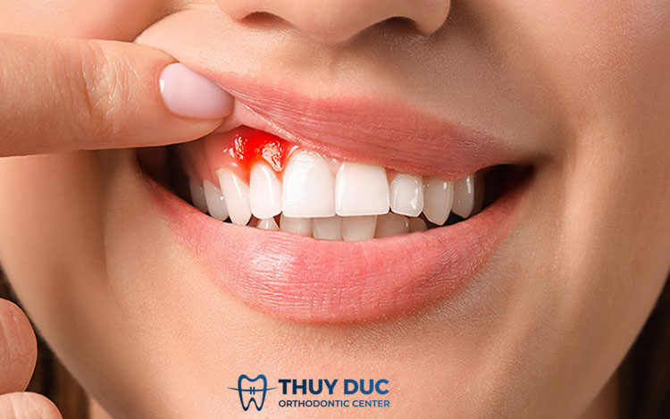 1/ Thường xuyên chảy máu chân răng là bệnh gì? 1