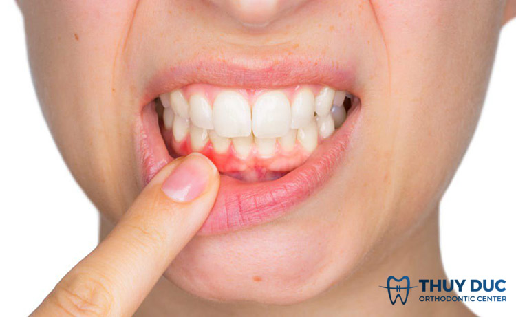 2. Sốt xuất huyết ảnh hưởng đến sức khỏe răng miệng thế nào? 1