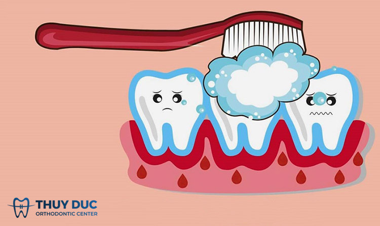 3. Sốt xuất huyết có nên đánh răng không? 1