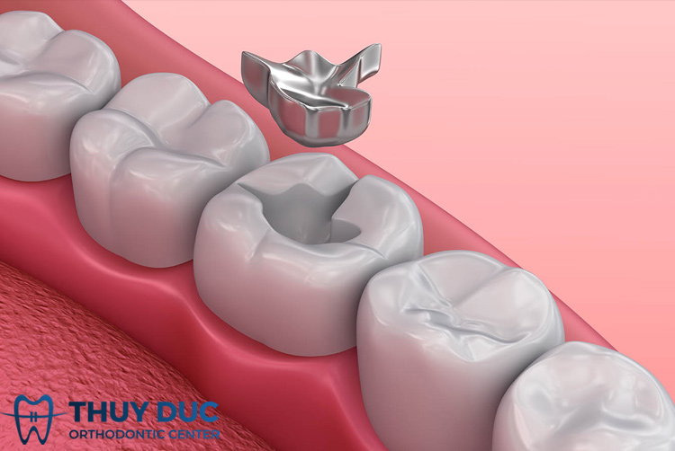 2.  Thành phần của amalgam 1