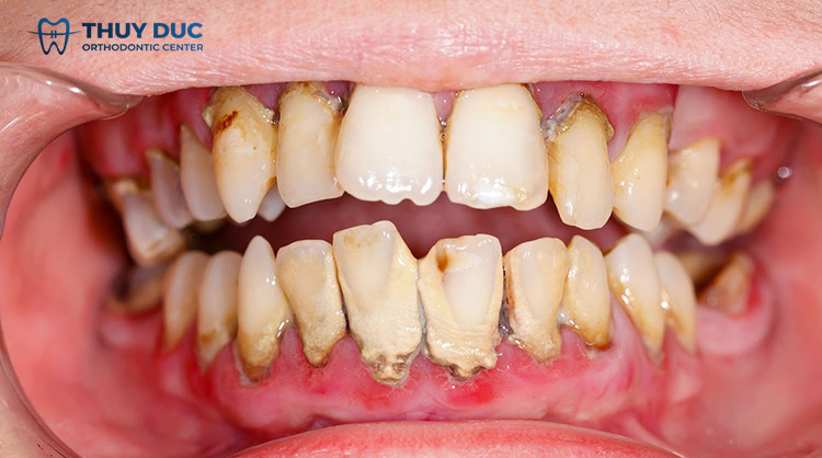 Nguy cơ gây ra bệnh lý răng miệng 1
