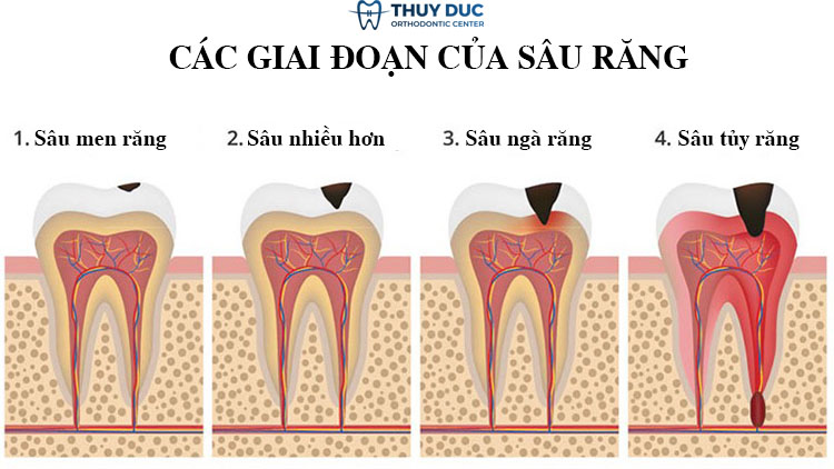 Các giai đoạn của sâu răng 1