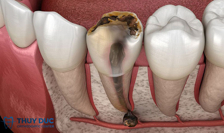 Viêm tủy răng là gì? 1