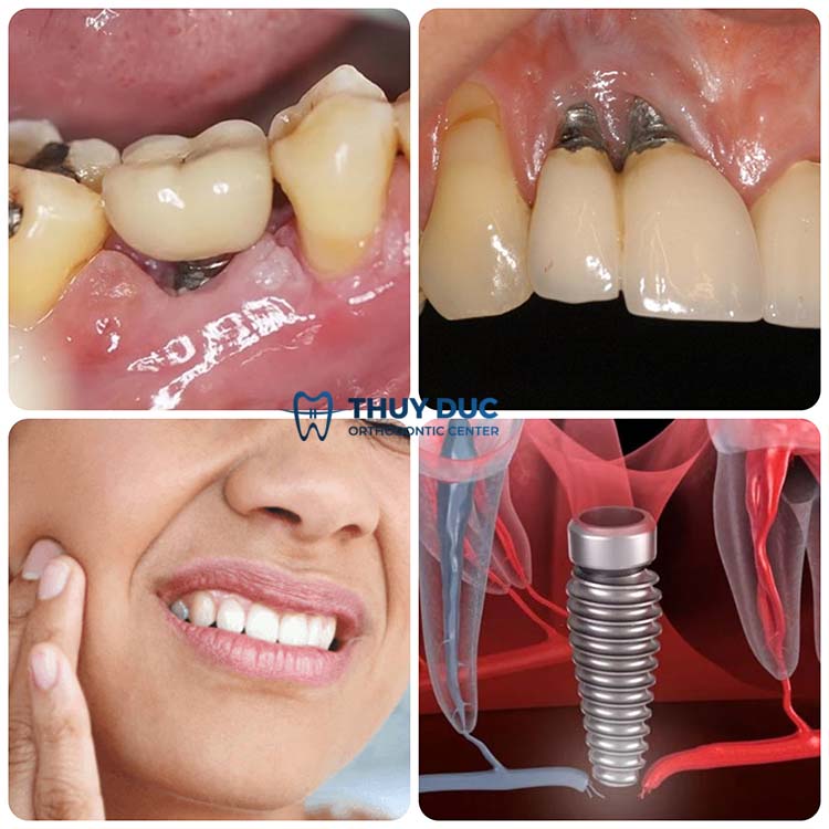 1. Các biến chứng khôn lường do trồng răng implant không đảm bảo 1