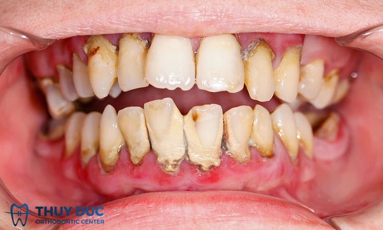 Cao răng độ 3 là gì? Mức độ nguy hiểm của cao răng độ 3 1