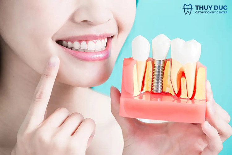 3. Cách khắc phục trồng răng implant bị giắt thức ăn 2