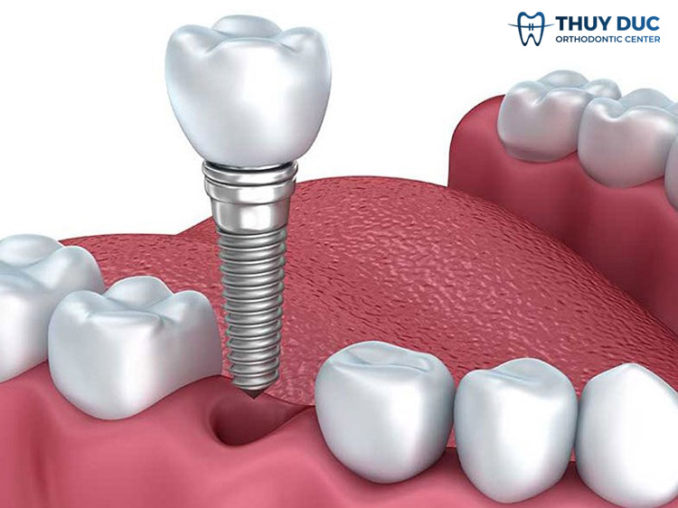 3. Cách khắc phục trồng răng implant bị giắt thức ăn 3