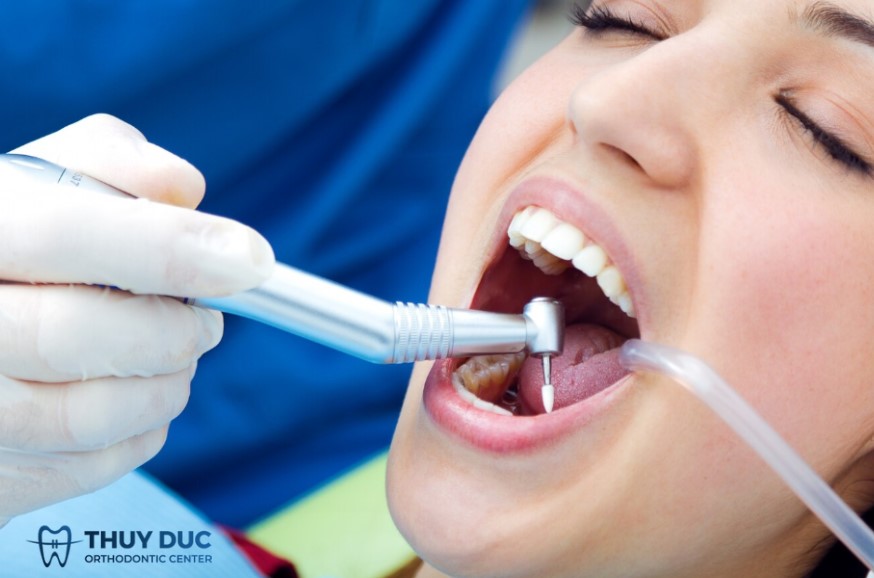2. Vì sao lấy cao răng xong bị ê buốt? 1