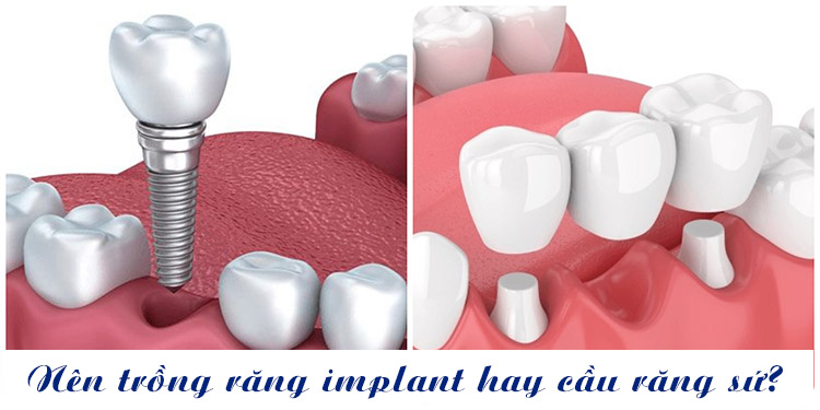 4. Nên trồng răng implant hay cầu răng sứ? 1
