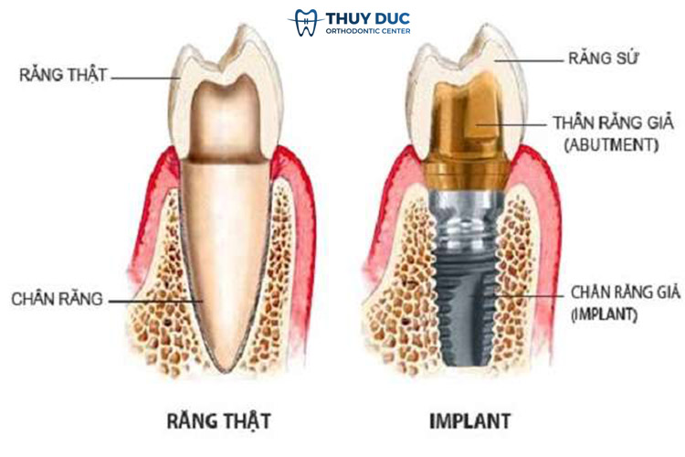 Do sự thay đổi tiếp xúc điểm qua thời gian giữa implant với răng thật 1