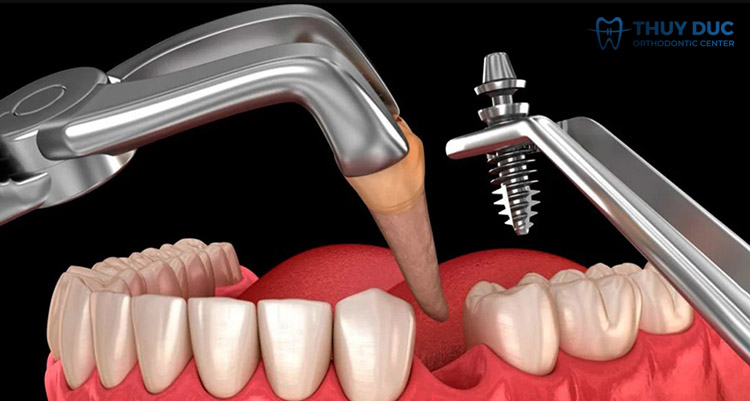 Khi nhổ răng xong, có thể bắt đầu quá trình trồng implant ngay 1