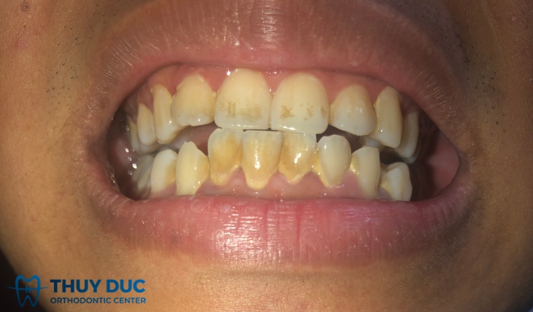Răng ố vàng là dấu hiệu bệnh gì? 1