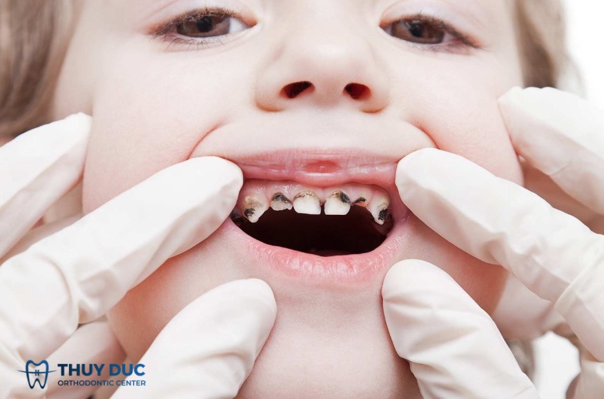 Bọc răng sứ cho trẻ em nên hay không? 1