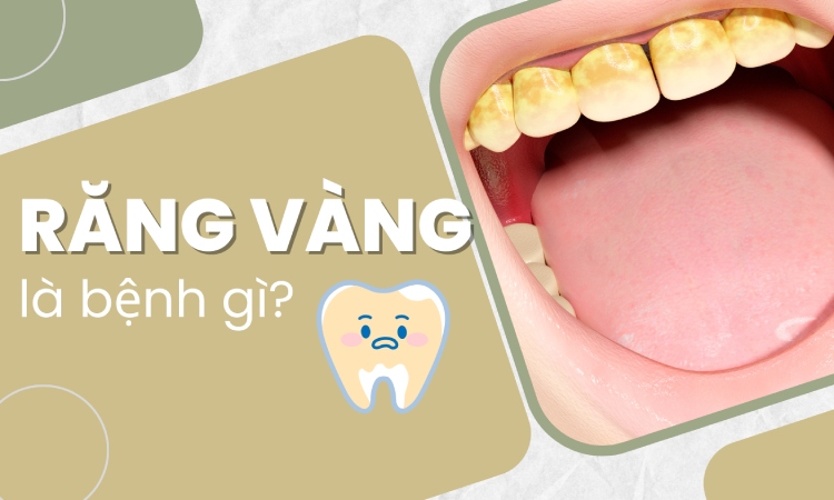 Răng vàng là bệnh gì? Điều trị hết bệnh có giúp răng trắng lại? 1