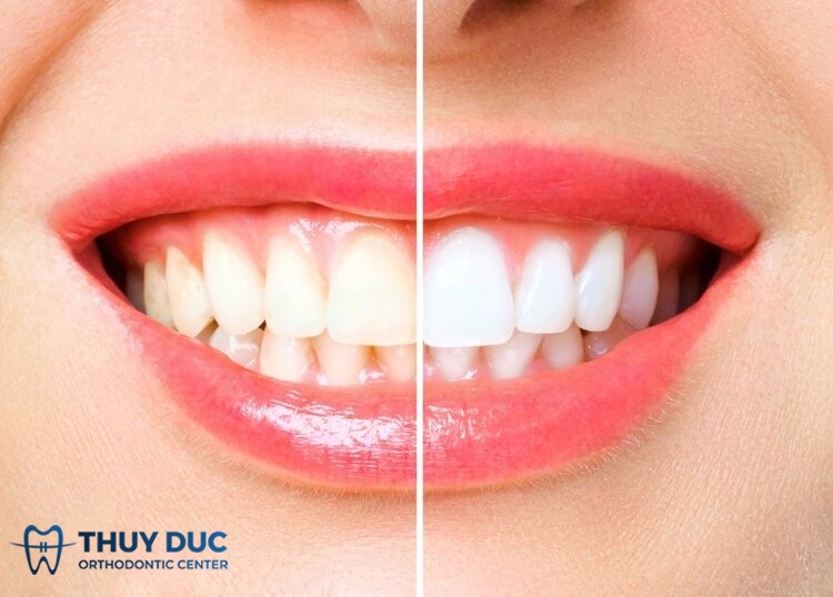 Phương pháp tẩy trắng răng hiệu quả tại nha khoa 1