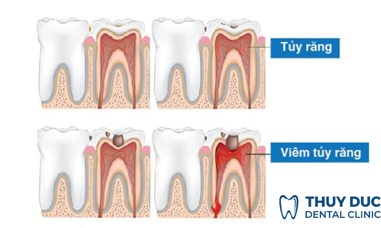 Viêm tủy răng là gì?  1
