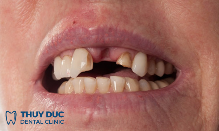 Hậu quả viêm tủy răng 1