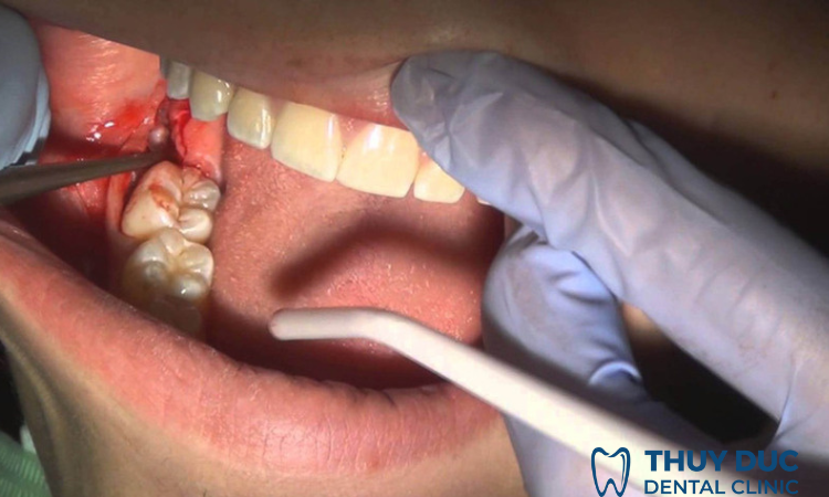 Điều trị áp xe răng ở mức độ cấp tính 1