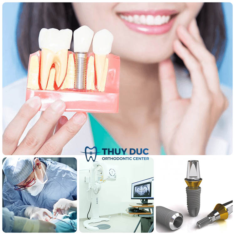 4. Một số tiêu chí chọn nha khoa trồng răng implant uy tín 1