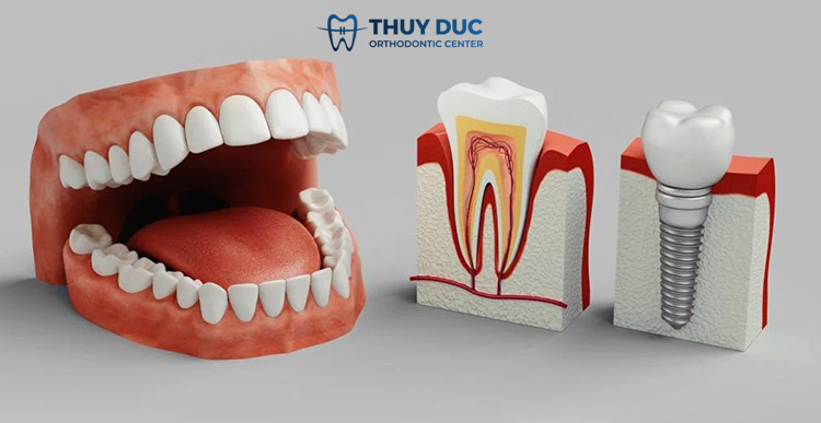 1. Trồng răng implant là gì? 1