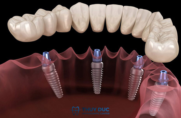 2. Vai trò của răng implant trong phục hình răng mất 1