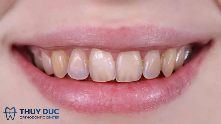 Răng ố vàng là dấu hiệu bệnh gì? 2