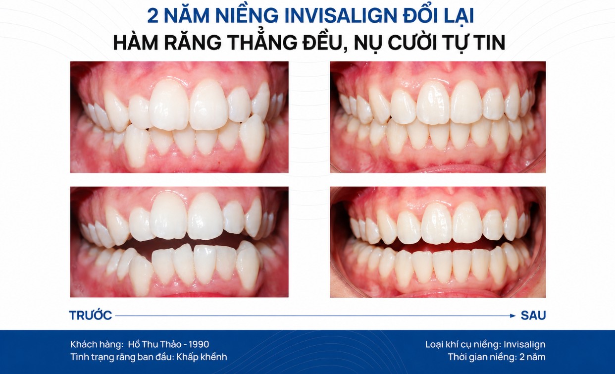 3. Sự khác nhau về phương pháp niềng 4