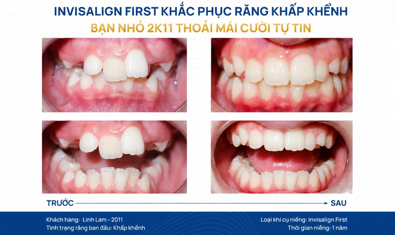 3. Sự khác nhau về phương pháp niềng 3