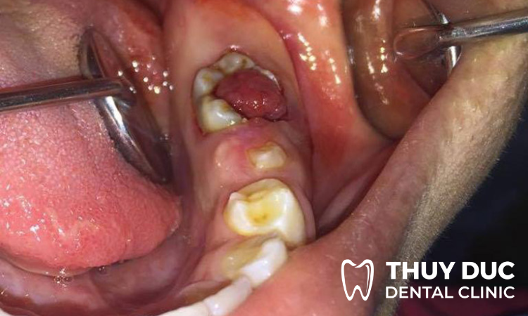 Viêm tuỷ răng khi nào cần điều trị? 1