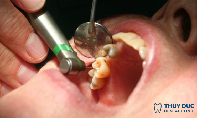 Điều trị viêm tủy răng có khả năng hồi phục 1