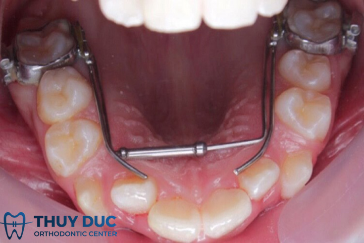 Cách xử lý tình trạng răng sữa không rụng mà răng vĩnh viễn vẫn mọc lên? 1