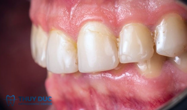 Một số bệnh liên quan đến tình trạng lợi chân răng bị trắng 1